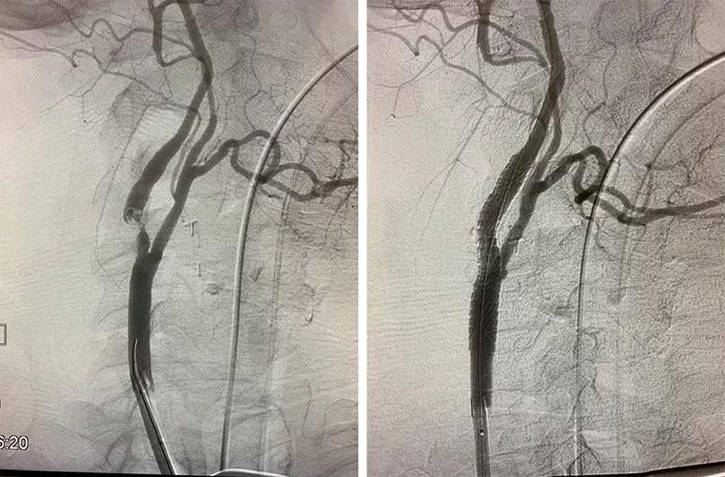 two angiograms side by side