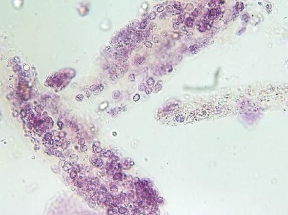 Figure 1. Urine microscopy showing red blood cell casts in a patient with active glomerulonephritis due to granulomatosis with polyangiitis (Wegener’s).
