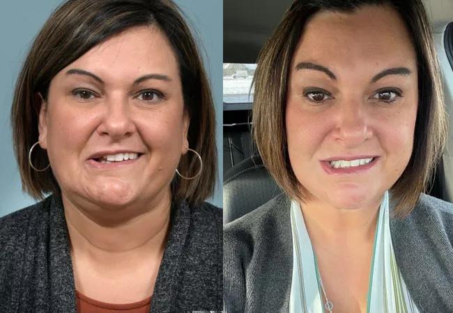 Bell's palsy