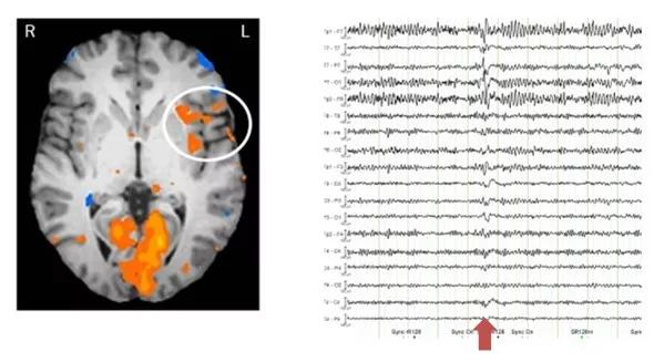  BOLD response recorded during an EEG/fMRI session. At the time of interictal epileptic spikes, the left anterior insula showed prominent cortical activation (circle), localizing the metabolic origin of the spikes. The posterior BOLD changes are expected in some patients undergoing EEG/fMRI and are not directly related to the origin of the patient’s epilepsy. EEG recorded simultaneously with the fMRI, with artifacts removed offline. The spike predominantly involved EEG electrodes recording from the left temporal region of the patient’s brain, concordant with the cortical activation shown by fMRI.