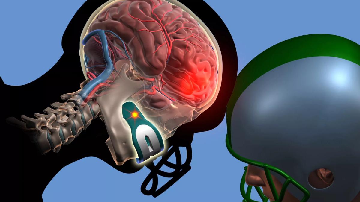 Cleveland-Clinic-Concussion-Mouthguard