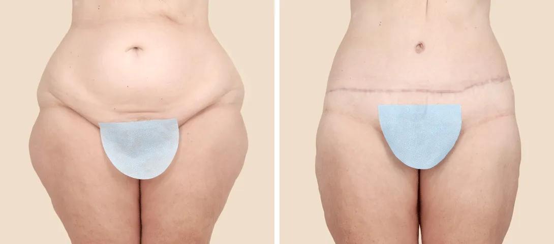 before circumferential abdominoplasty (left) and 5 months after (right).