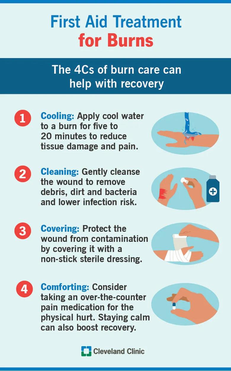 First aid treatment for burns, the 4cs of burn care