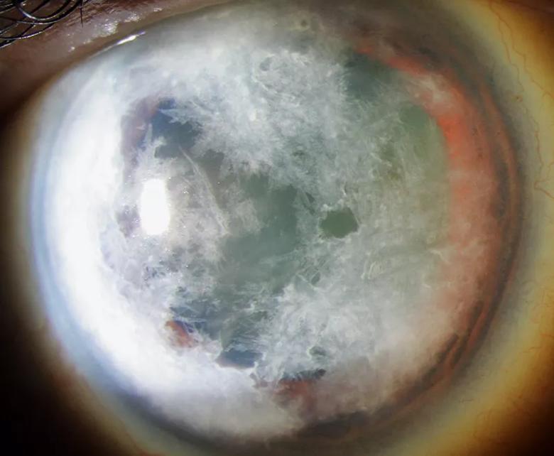 Eyeball with cloudy white surface