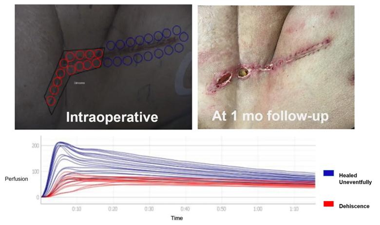 Skin incision after surgery and graph of measurements