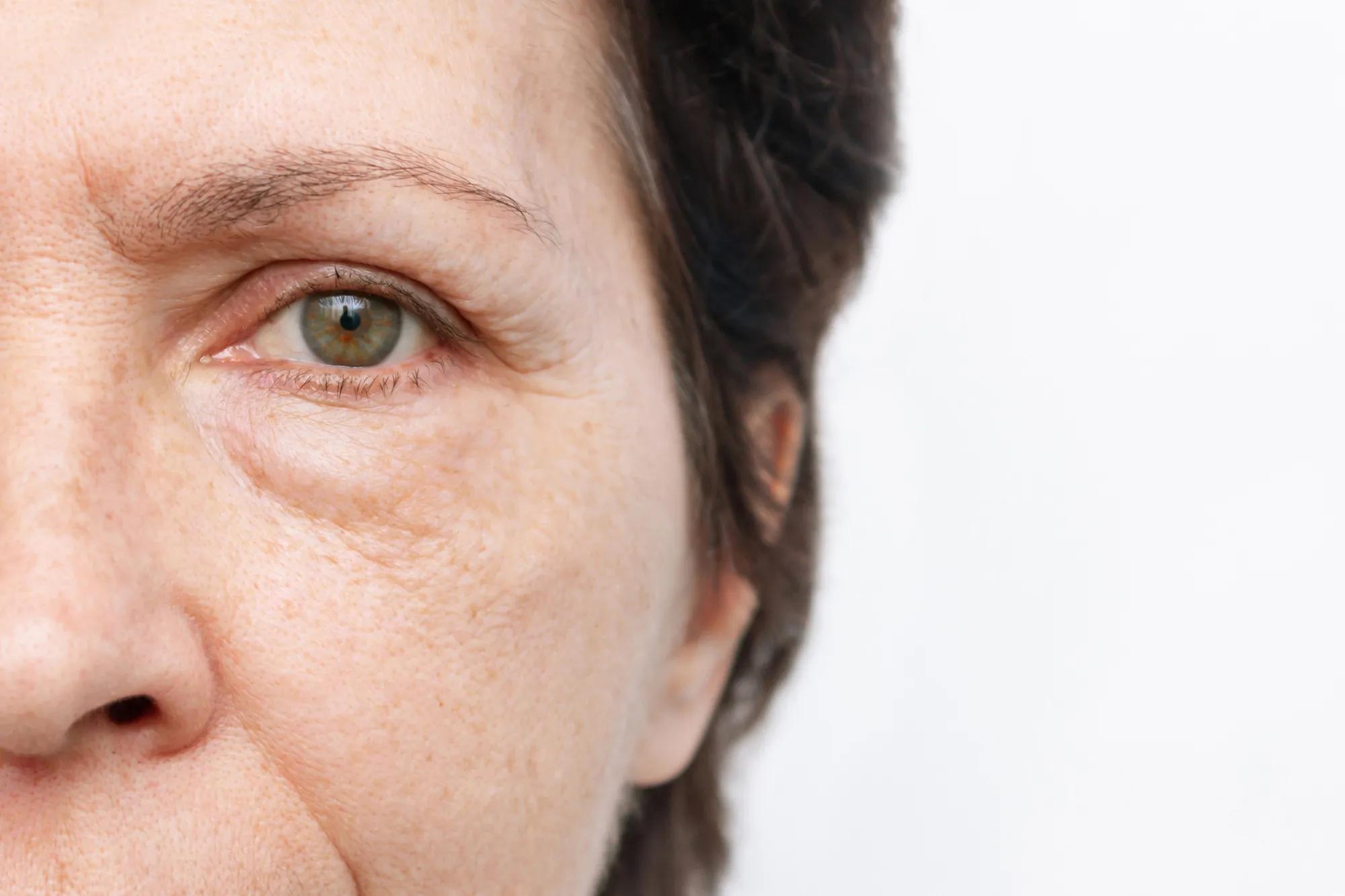 Bags under eyes puffy discount