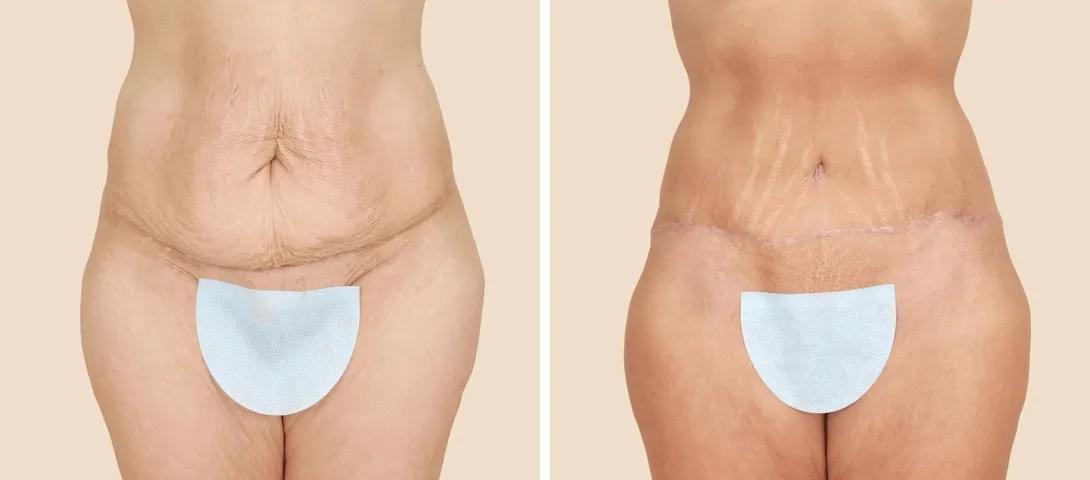 Before abdominoplasty (left) and not even 2 months after surgery (right).