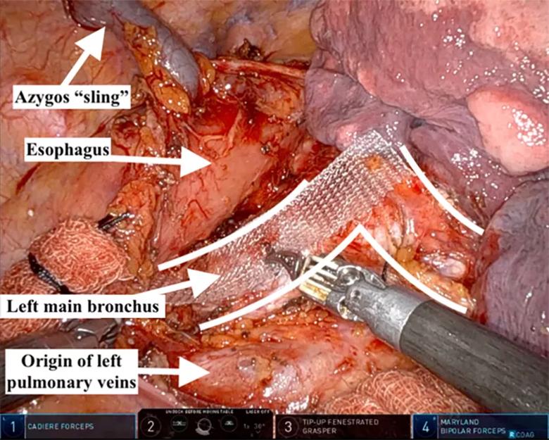 intraoperative photo of robotic tracheobronchoplasty