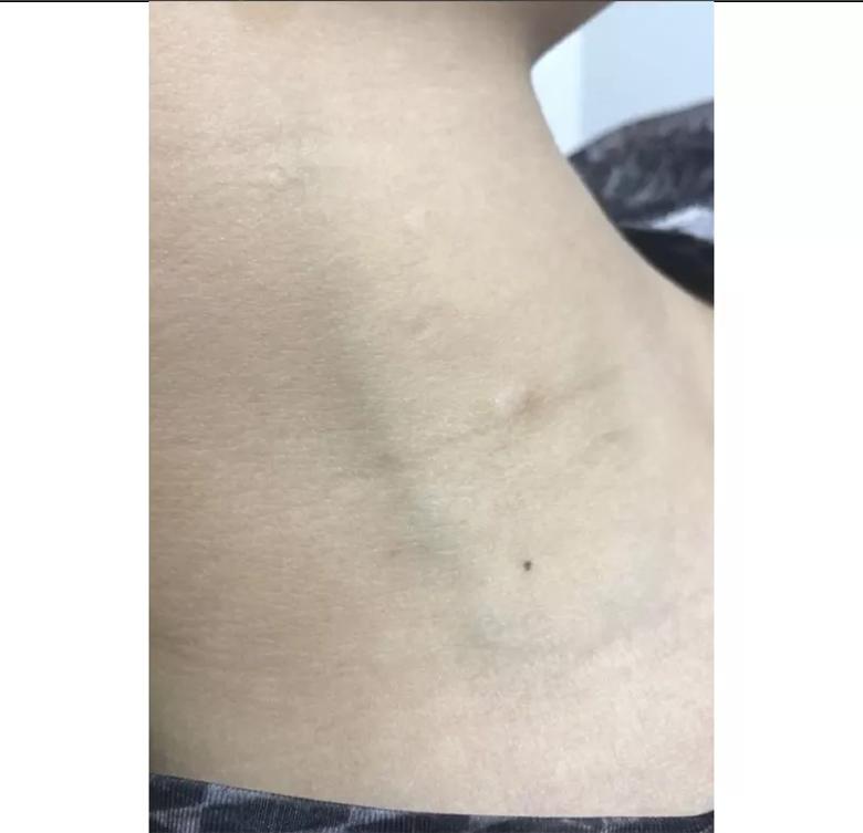 jugular venous distention