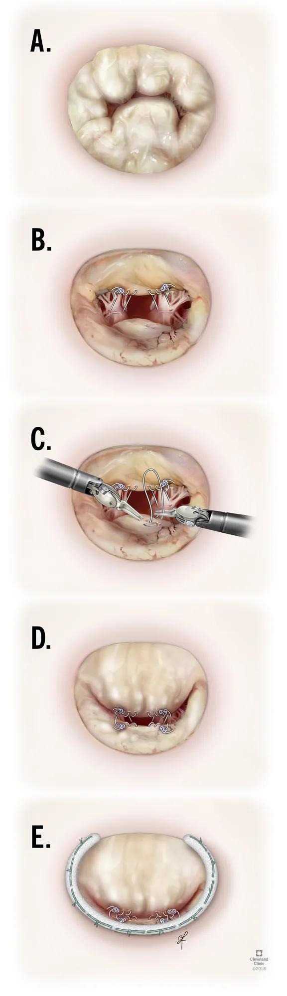five illustrations showing steps in a robotic heart valve operation