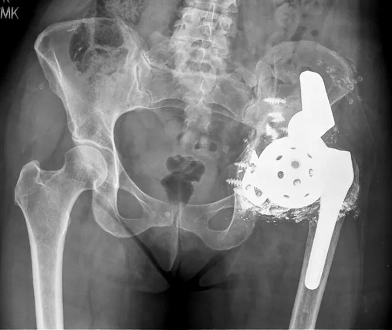 X-ray of loose hip implant