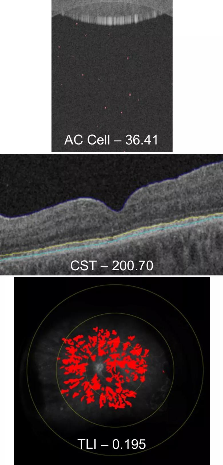 Imaging of patient with intraocular inflammation