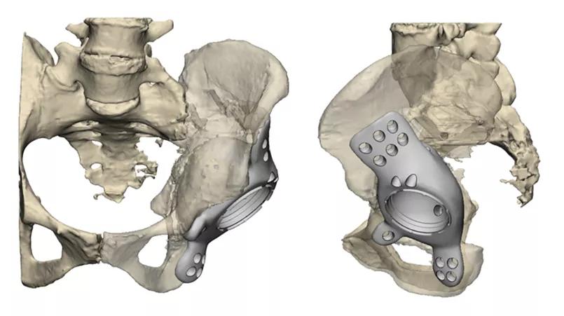 Final implant plan