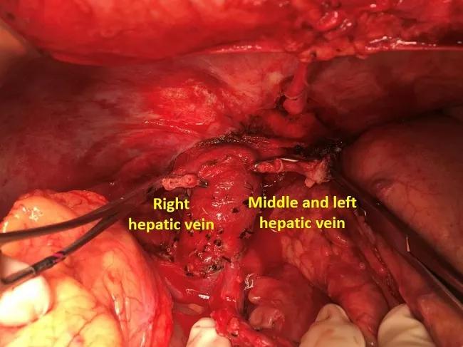 Separated hepatic veins in preparation for creating the venous cuff, which will augment graft outflow.