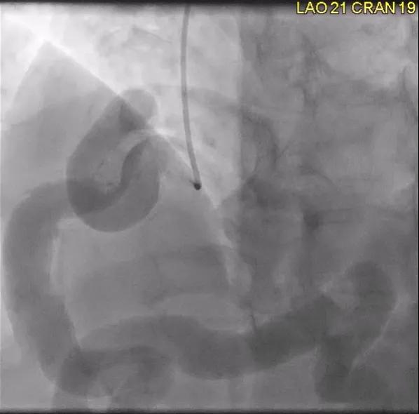 heart angiogram showing an aneurysm of coronary artery