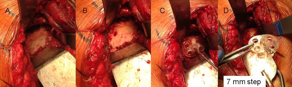 Shoulder surgery