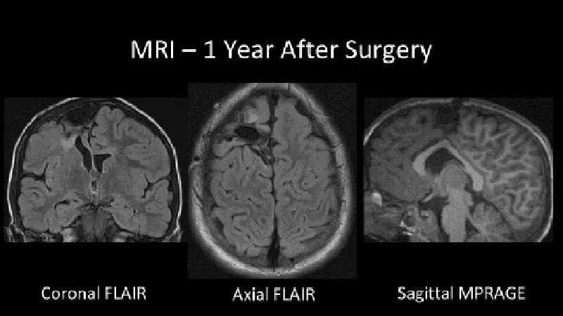 MRI of the brain