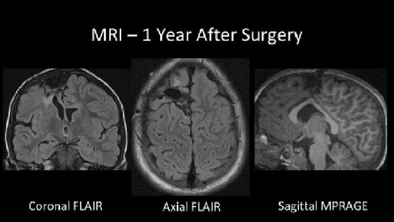 MRI of the brain
