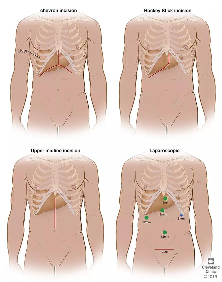 Different kinds of incisions