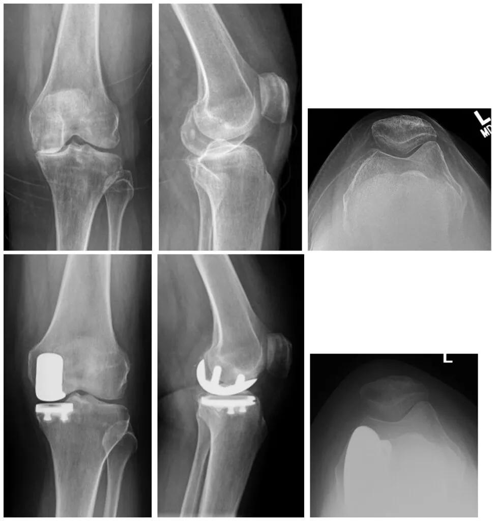X-rays after unicompartmental knee arthroplasty