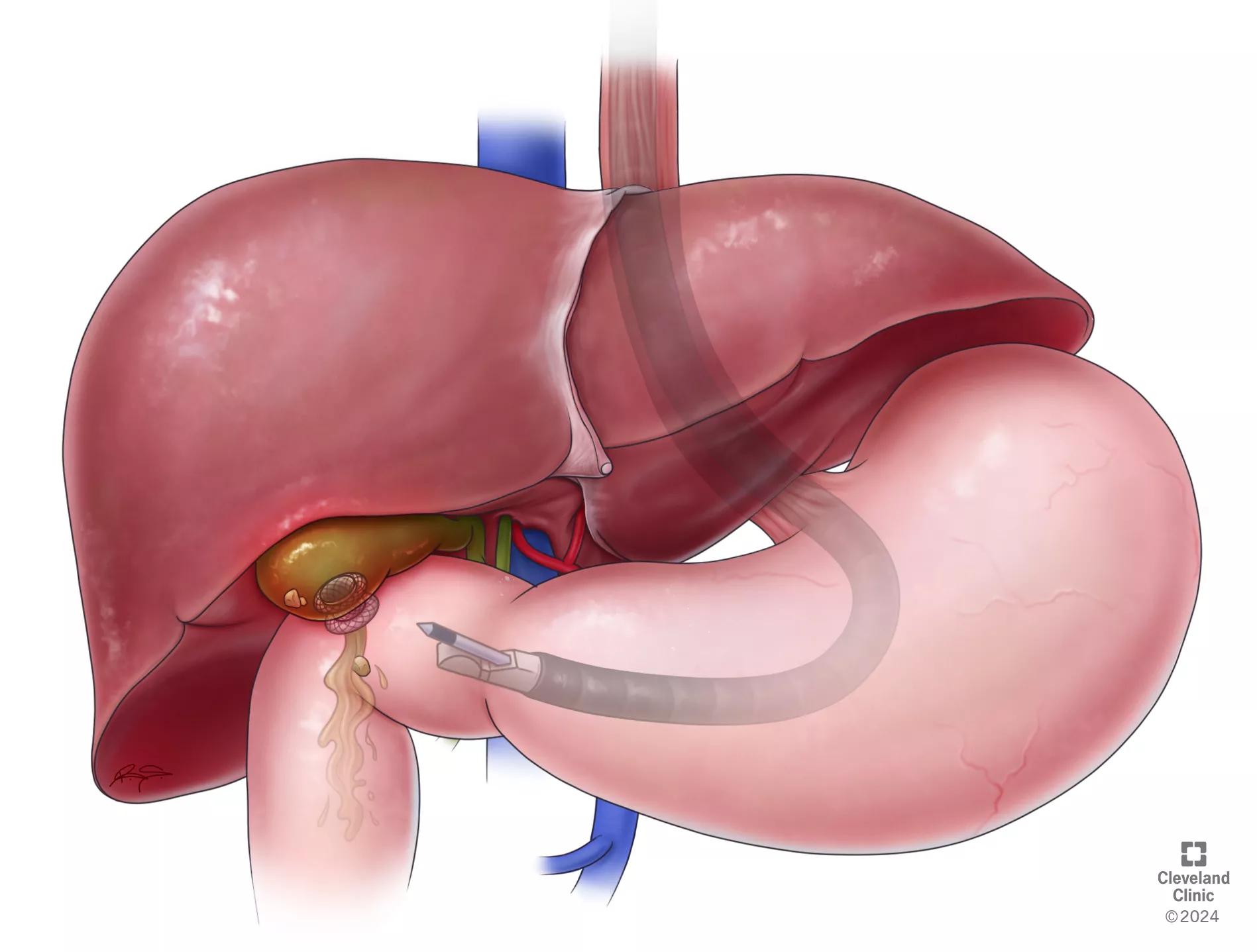 EUS Guided Cholecystostomy illustration