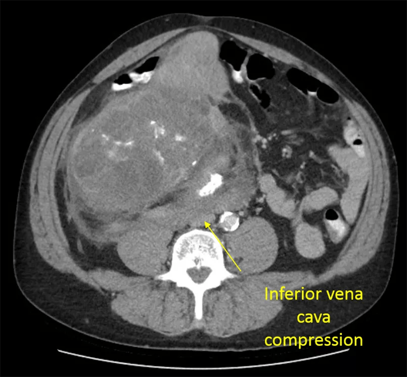CT scan