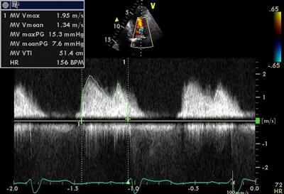 Figure 2. Continuous-wave Doppler echocardiogram of the patient’s mitral valve upon presentation.