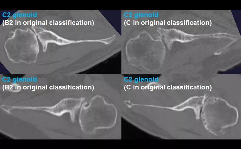 Shoulder arthritis
