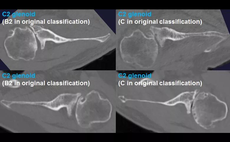Shoulder arthritis