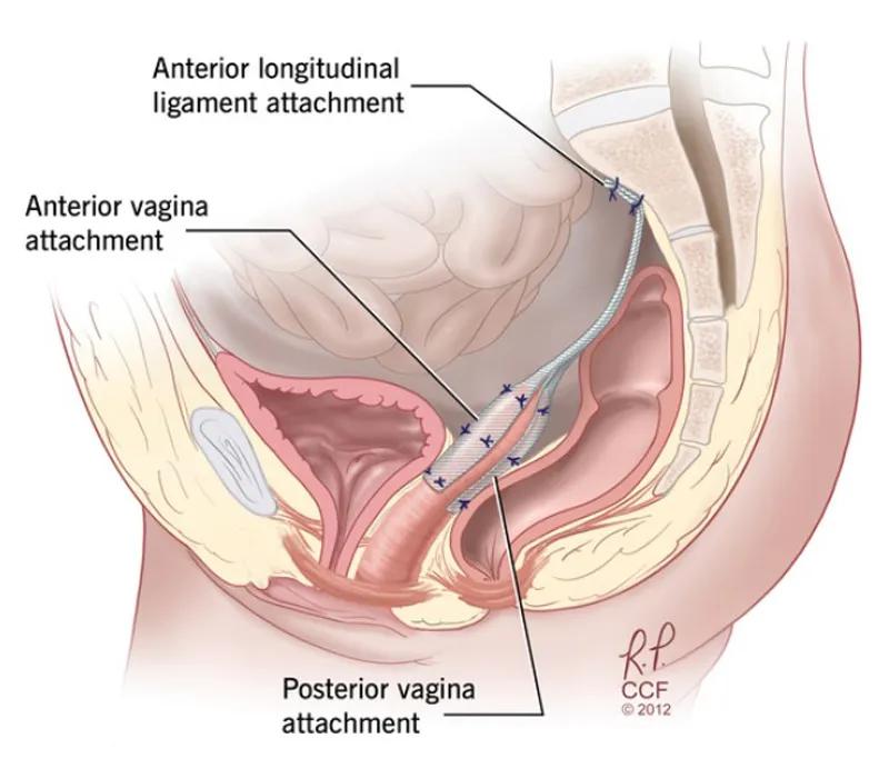 medical illustration of sacral colpopexy 