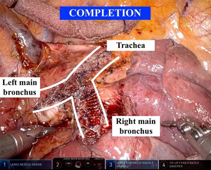 intraoperative photo of tracheobronchoplasty completion