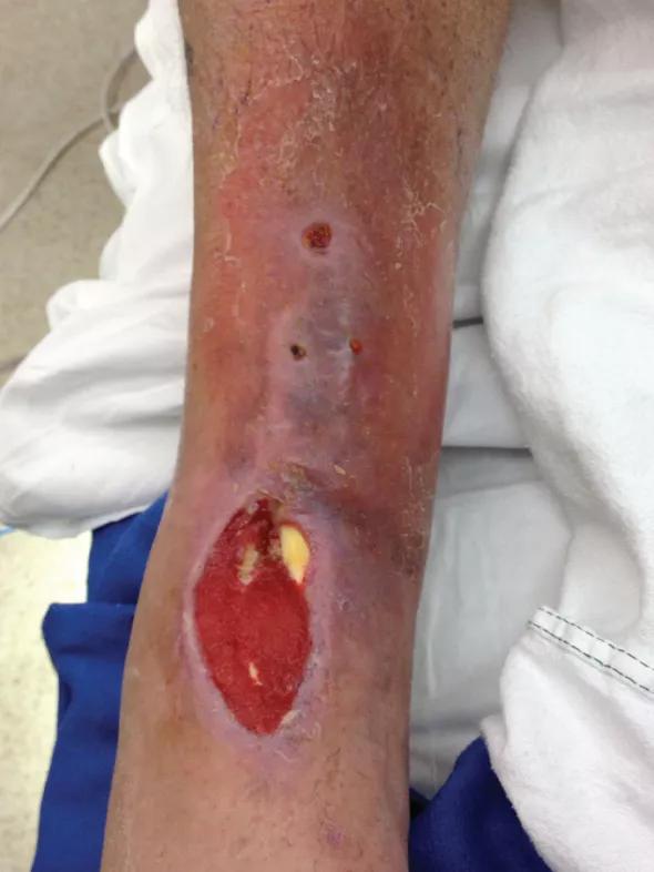 Figure 1. An example of anterior skin compromise that may prompt consideration of a posterior approach to ankle fusion.