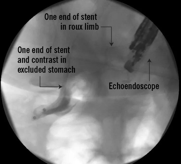 The view from Cleveland Clinic’s first endoscopic ultrasound-directed transgastric ERCP