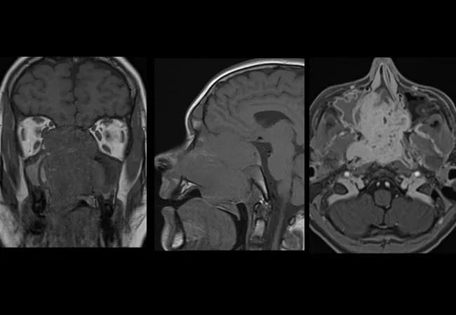 MRI showing nasal mass