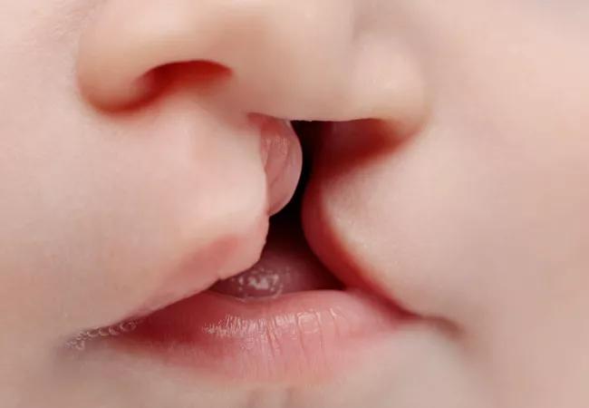 The Way to Go for Cleft Palate Repair