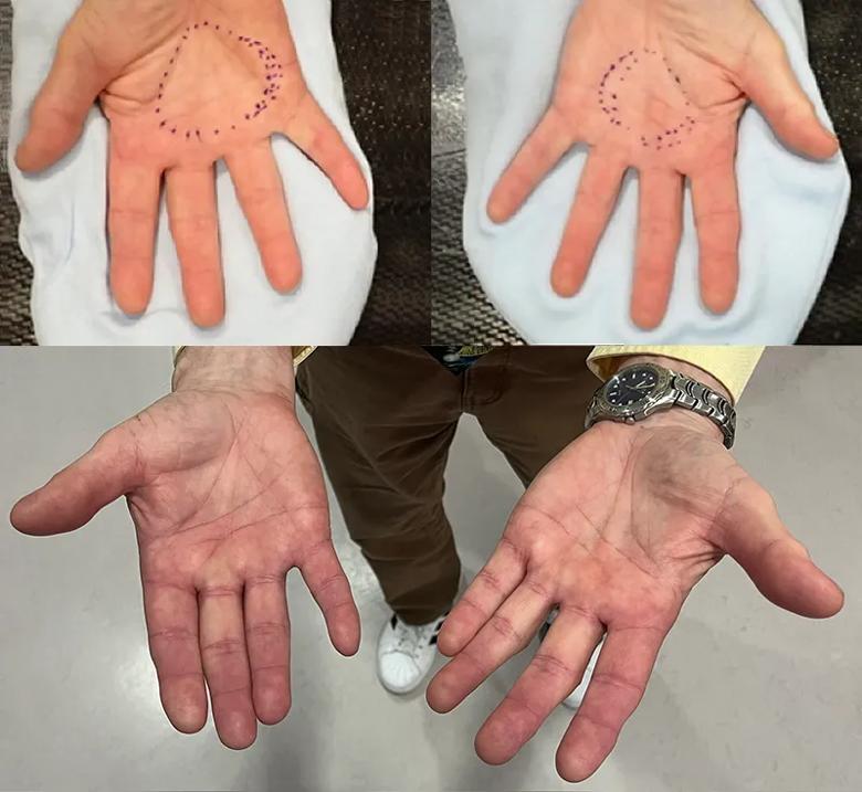 before and after radiation therapy