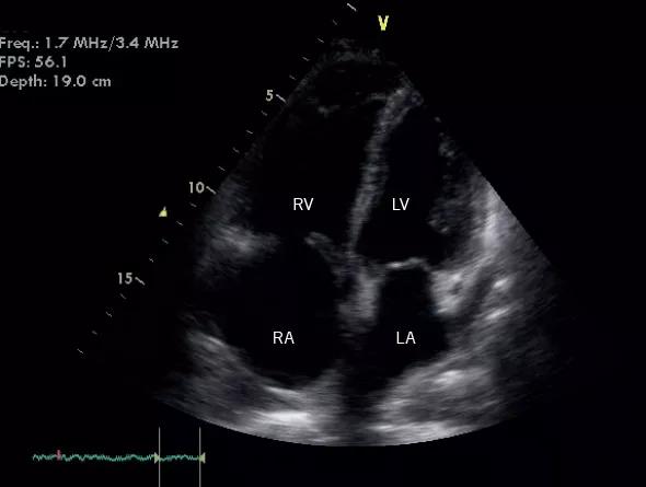 Figure 1. Transthoracic echocardiogram (apical four-chamber view) in a 66-year-old man with polymyositis associated with antisynthetase (anti-Jo-1) syndrome. The right ventricle (RV) is severely dilated, and the right atrial cavity (RA) is also dilated. The left ventricle (LV) and left atrium (LA) are normal in size and systolic function