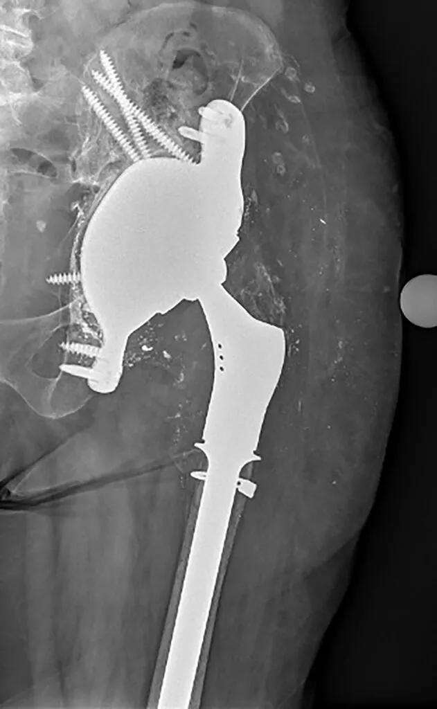 Final placement of the 3D-printed implant