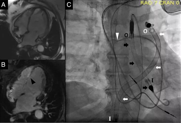 Biventricular impella