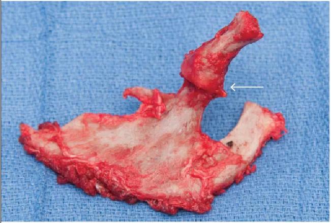Figure 3. En bloc resection of the first rib and attached cervical rib. Arrow notes the articulation joint in the cervical rib.