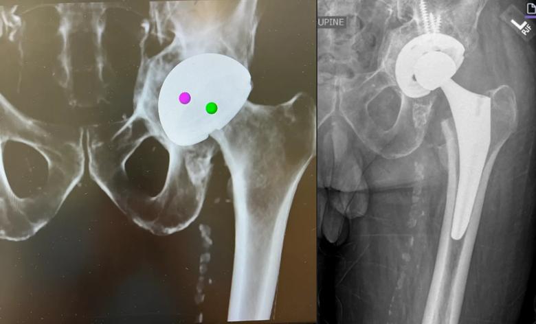 Robotic planning and X-ray of hip replacement