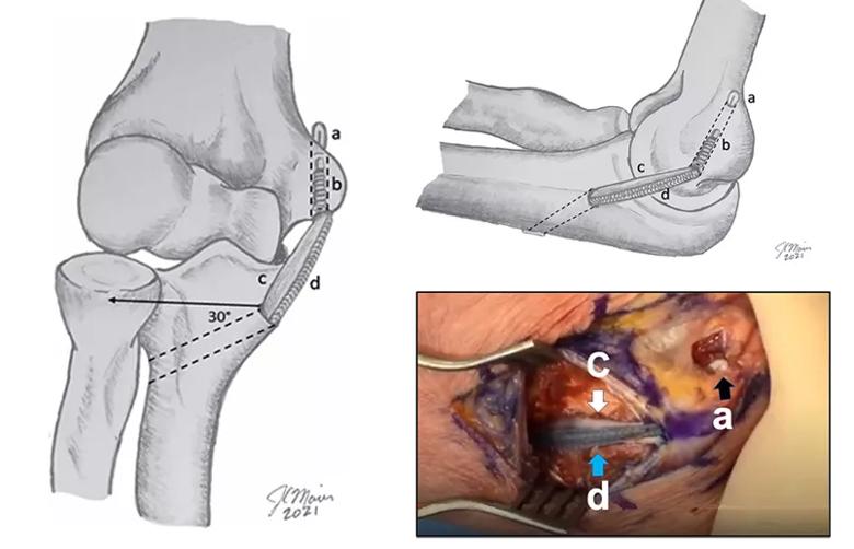 Novel adjustable, dual suspensory UCL reconstruction technique.