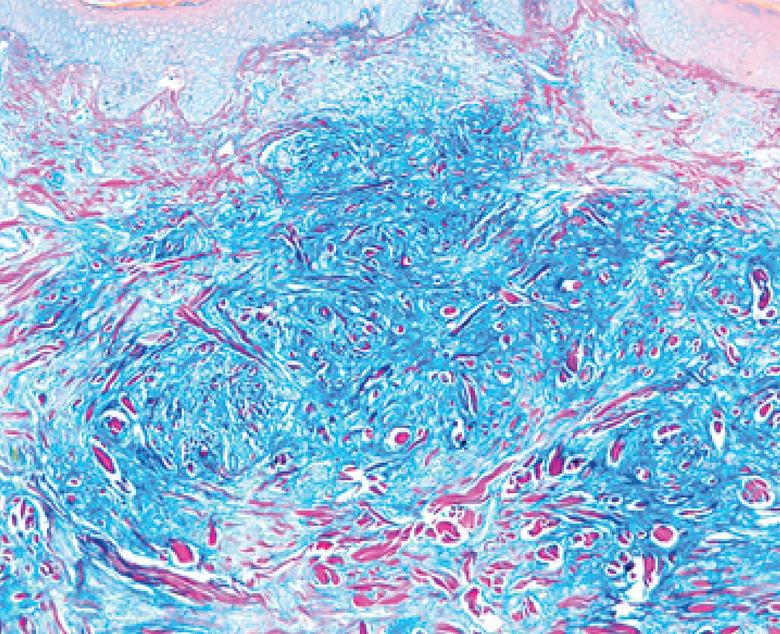 increased dermal mucin deposition