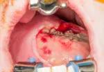 Figure 1. Soft palate tumor in situ