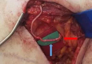 Coaptation of the nerve allograft and nipple-areolar complex