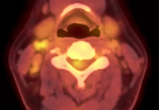 glp-1 vomiting legal team in west virginia Patients are suing over alleged side effects of weight-loss drugs | E-News