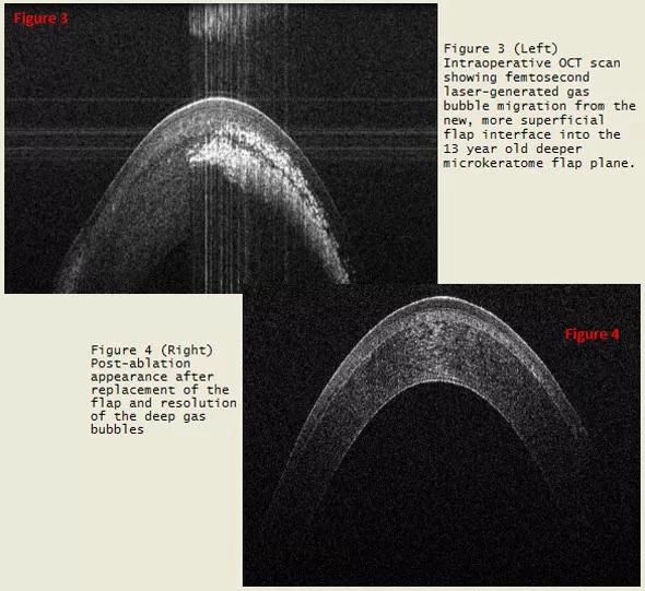 Enhancement 13 Years After Lasik