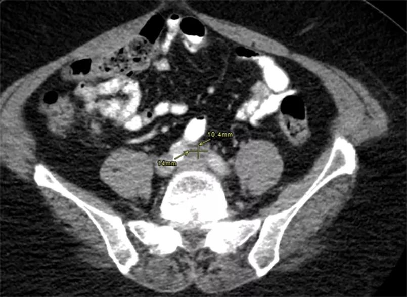 CAT scan showing decrease in size of soft tissue thickening 