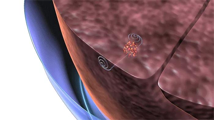 Lung microcoil Cleveland Clinic