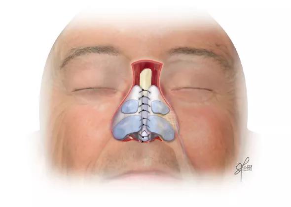 14-ENT-2015-Fritz-Inset-Image-Fig-1-590pxl-width
